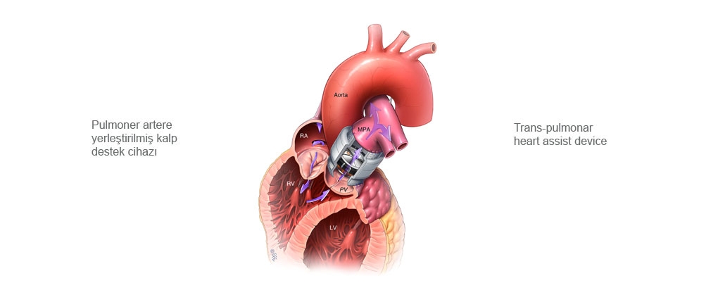 Transarteriyel kalp destek cihaz