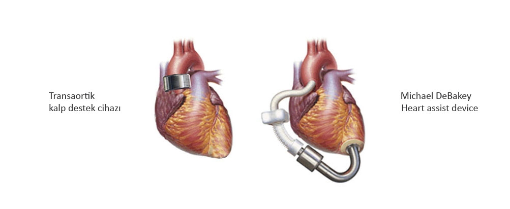 Transarteriyel kalp destek cihaz